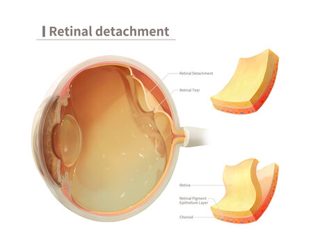 Retinal detachment, illustration