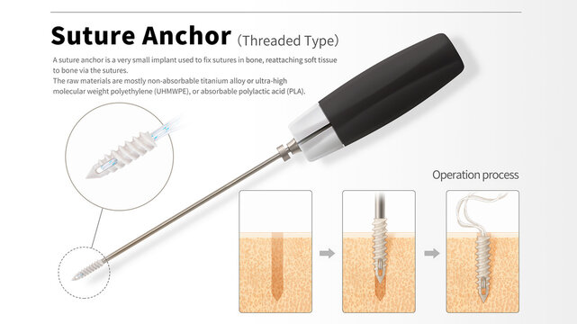 Suture anchor, illustration