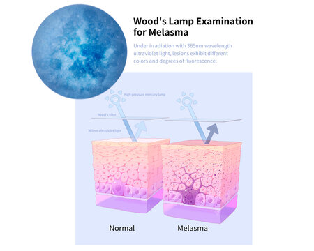 Wood's lamp skin exam for melasma, illustration