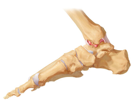 Anterior ankle impingement syndrome, illustration
