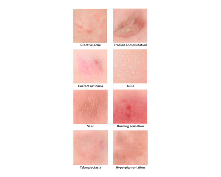 Improper chemical peel symptoms, illustration