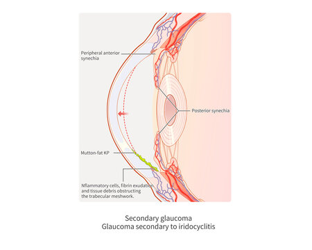 Secondary glaucoma from iridocyclitis, illustration