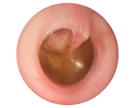 Secretory otitis media, illustration