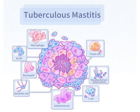 Breast tuberculosis nodule, illustration