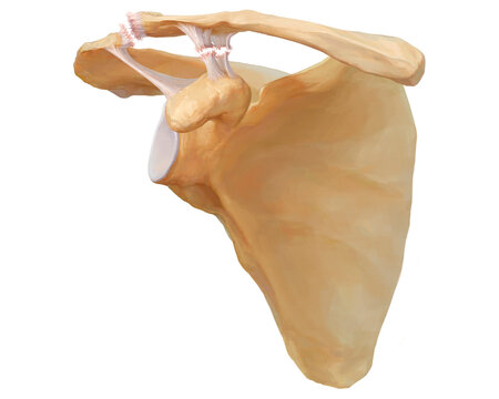 Acromioclavicular dislocation type III, illustration