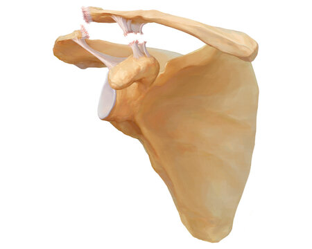 Acromioclavicular dislocation type V, illustration