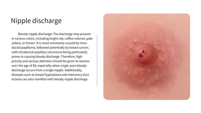 Bloody nipple discharge, illustration