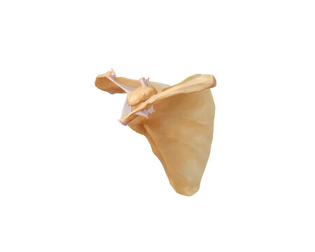 Acromioclavicular dislocation type VIb, illustration