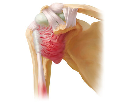 Adhesive capsulitis, illustration