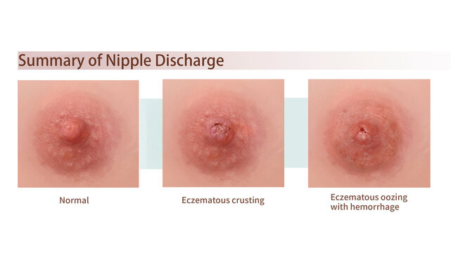 Extramammary Paget disease clinical features, illustration