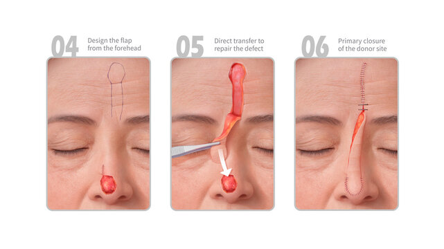 Forehead flap integration, illustration