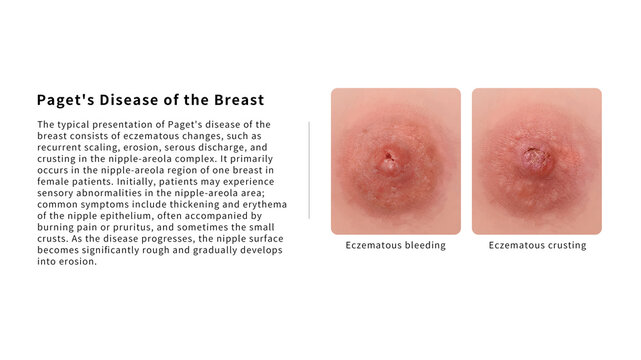 Extramammary Paget disease clinical features, illustration