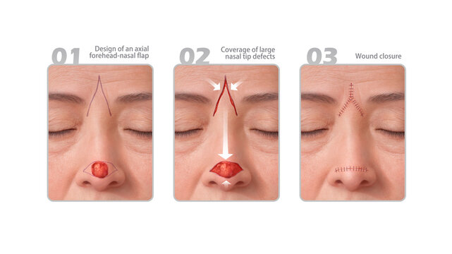 Axial frontonasal flap integration, illustration