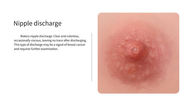 Clear nipple discharge, illustration