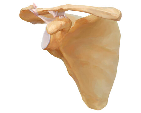 Acromioclavicular dislocation type VIa, illustration