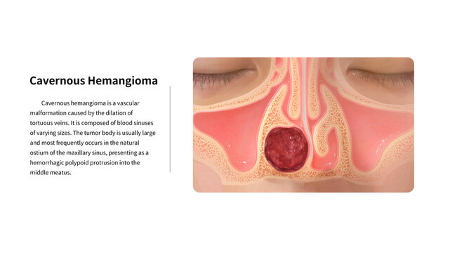 Nasal cavity cavernous haemangioma, illustration