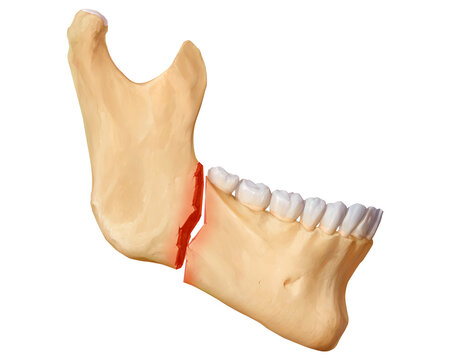 Mandibular angle fracture displacement, illustration