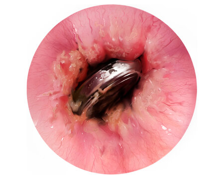 Oesophageal button battery foreign body, illustration