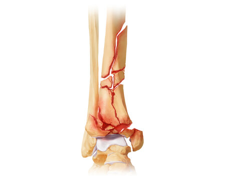 Distal tibia fracture AO-C3.3, illustration