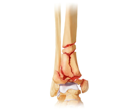 Distal tibia fracture AO-C3.2, illustration