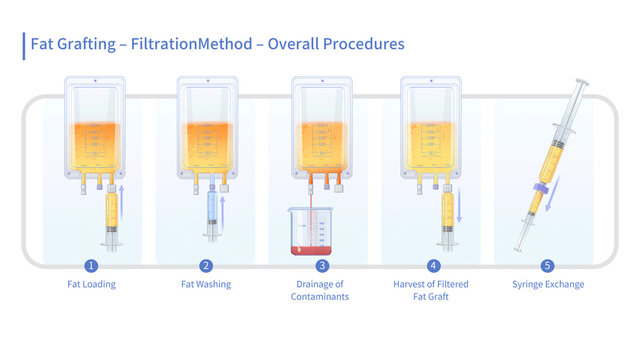 Fat graft filtration, illustration