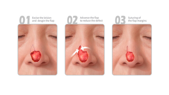 Forehead flap combined with integration, illustration