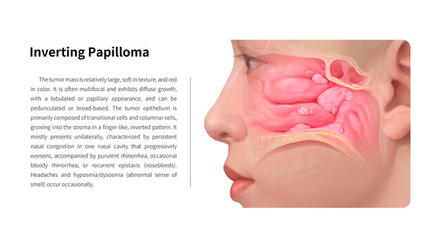 Inverted papilloma, illustration