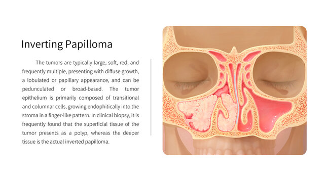 Inverted papilloma, illustration