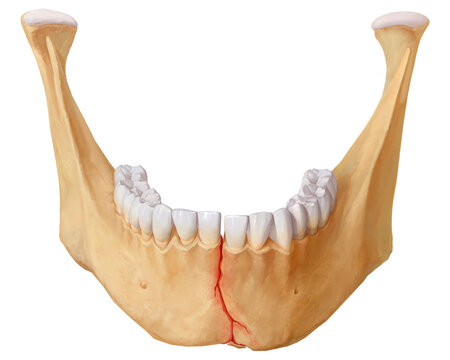 Mandibular symphysis linear fracture, illustration