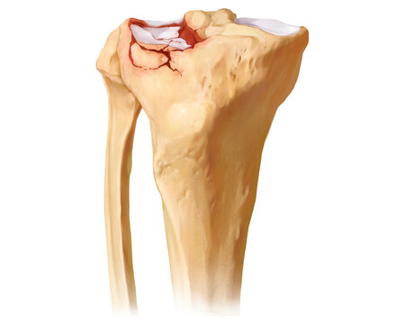 Tibial plateau fracture Schatzker III, illustration