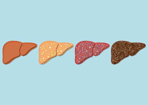 Stages of liver disease, illustration