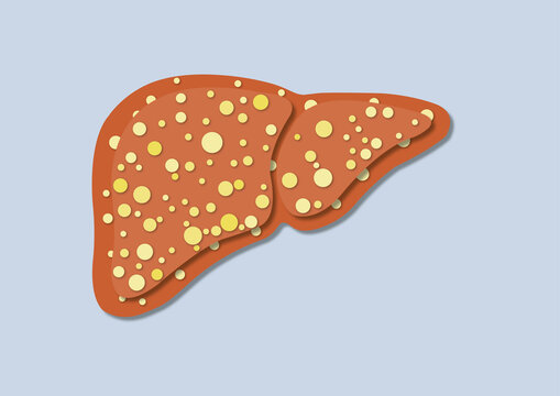 Fatty liver disease, illustration
