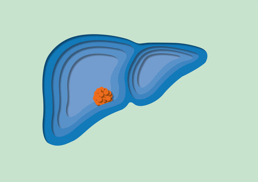 Liver cancer, illustration
