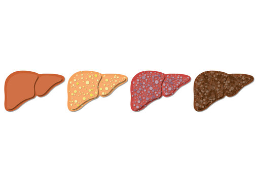 Stages of liver disease, illustration