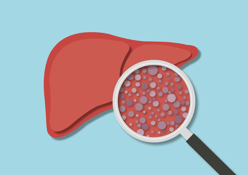 Liver fibrosis, illustration