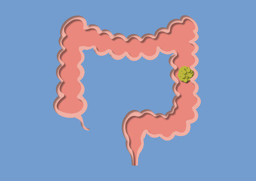 Colon cancer, conceptual illustration
