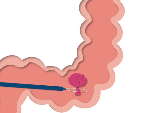Colon polyp removal, conceptual illustration