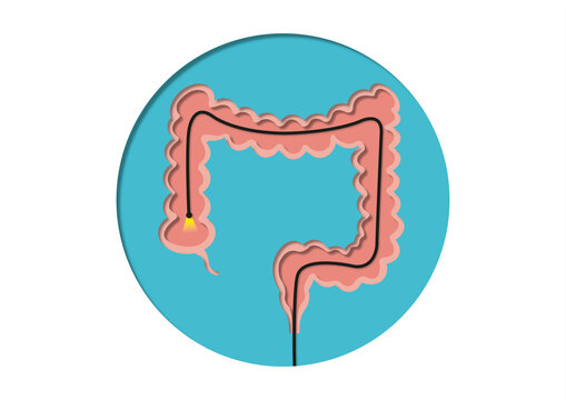Colonoscopy, conceptual illustration