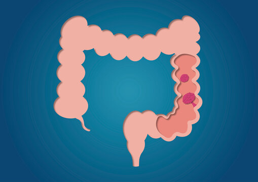 Colon polyps, conceptual illustration