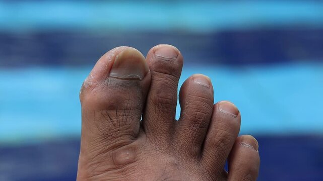Close-up of a human foot with visible calluses and toe bumps. Blue pool water blurs softly in the background. Foot shows signs of wear, natural skin texture, and slight swelling