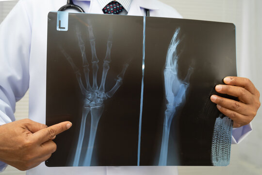 Doctor examining hand ankle joint bone radiography xray film.