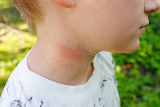 Red swollen wasp sting on child neck skin