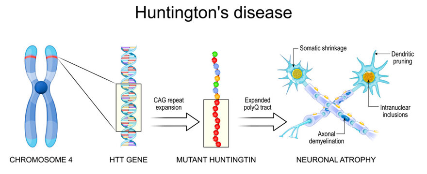 Huntington's Disease HD. Huntingtons chorea from genetic mutation Chromosome and DNA location, mutant huntingtin protein to neuronal degeneration