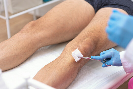 Medical worker swabs knee skin with antiseptic using forceps. Gloved hand. Preparing patient for injection procedure. Clinical disinfection