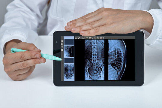 Doctor pointing with a pen at a lumbar spine X-ray scan on a tablet display. Lumbar osteochondrosis and intervertebral disc hernia treatment.