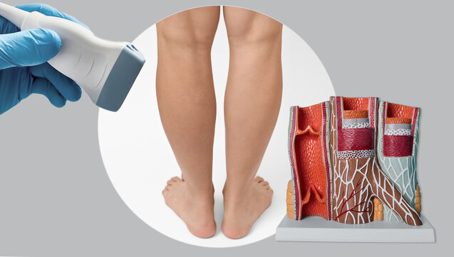 Female legs shown with a cross-section vein model and medical scanner. Deep vein thrombosis risk, blood clot prevention, and vascular health diagnostics.