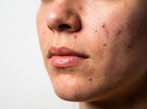 Close up of young woman face with visible acne breakouts and textured skin
