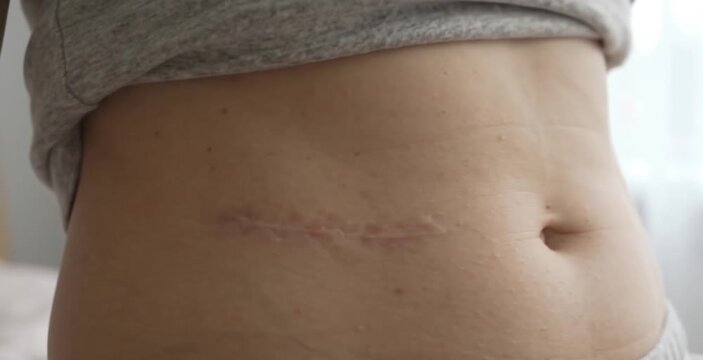Close Up of Healed C Section Surgical Scar Across Woman Lower Abdomen