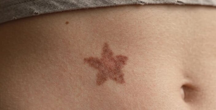 Macro Close Up of Unique Star Shaped Brown Birthmark on Woman Stomach