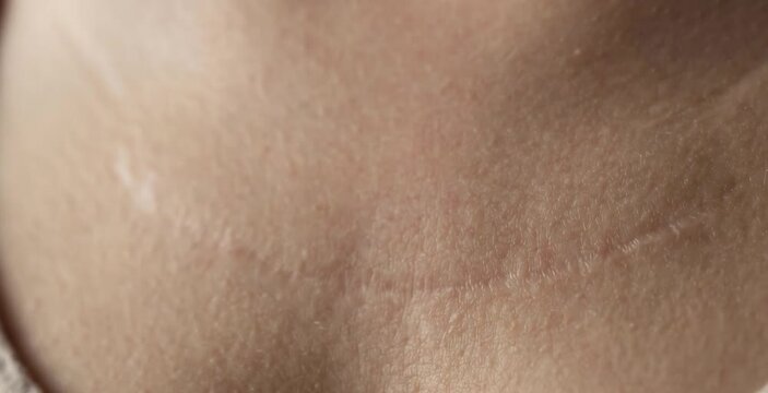 Close Up of Healed Curved Surgical Incision Scar Across Woman Chest and Sternum